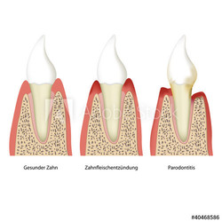 parodontitis tooth plaque vector illustration