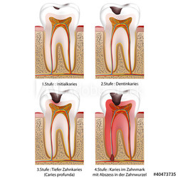 4 stufen des karies im zahn vektor illustration