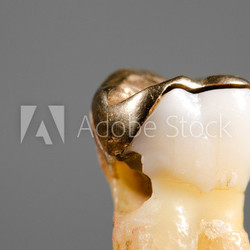 non fitting gold inlay and therefore decay, hole