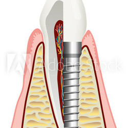 Zahnimplantat / Implantologie