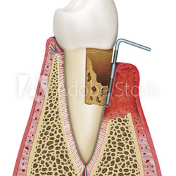 gingivitis con avanzadas