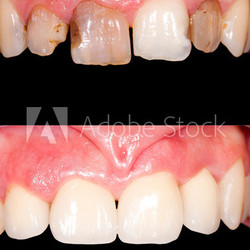 Dental restoration