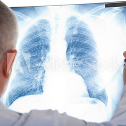 Doctor examining a lung radiography