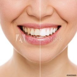 Before and after bleaching or whitening treatment, isolated