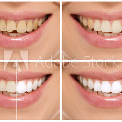 Teeth decay cure. Tooth whitening. Before and after.